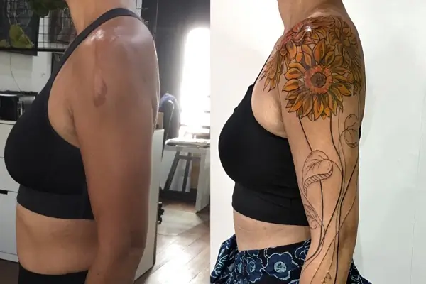 Scar Cover ups